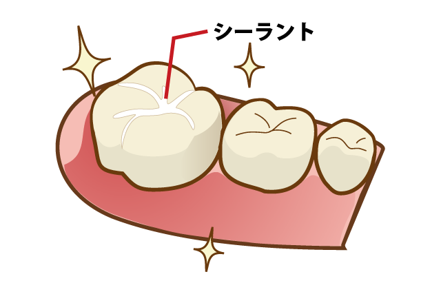 シーラント